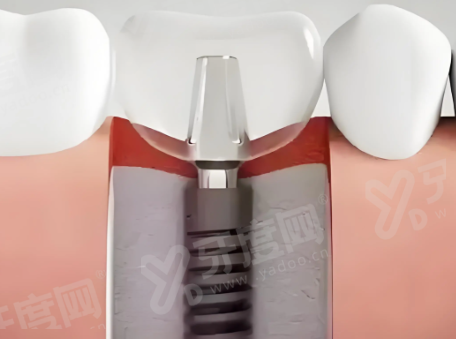 四、惠州深惠口腔种植牙预约指南yanke.yadoo.cn