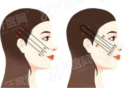 皮贴骨提升针打什么牌子好？成都艾米丽选乔雅登濡白天使，骨膜支撑紧致自然