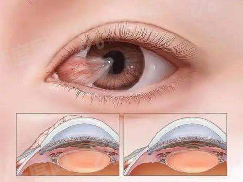 三、信阳尖峰眼科医院价格表？（项目收费透明，公开合理）yanke.yadoo.cn