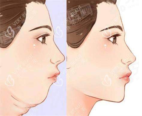 成都艾米丽整形抽脂怎么样？正规资质威塑技术精细塑形线条自然流畅