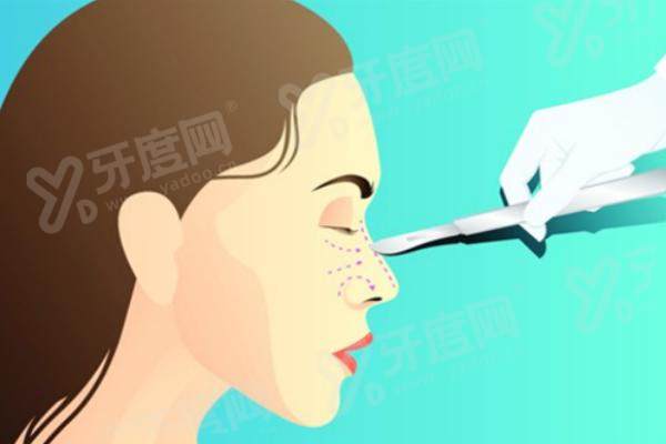 深圳鹏程医院整形美容中心做鼻子怎么样？肋软骨修复自然技术好，收费透明