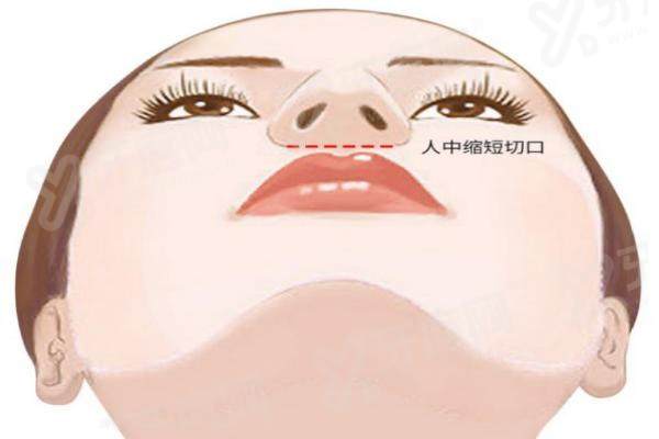 卢九宁人中缩短术做得好吗？真实案例验证：精细操作切口隐蔽，术后人中比例协调效果佳