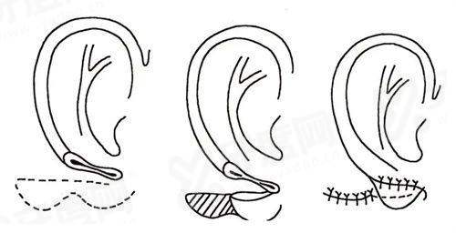 北京魏志香做卧蚕再造怎么样？注重分层注射和联合调整，卧蚕既自然又灵动