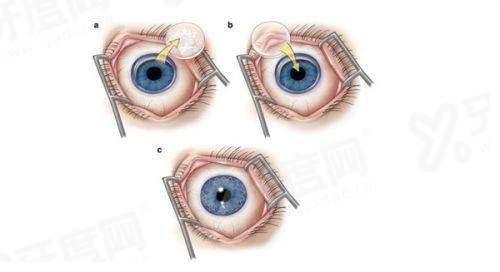 三、湘雅二医院眼科价格表?(常见项目收费标准公示)yanke.yadoo.cn