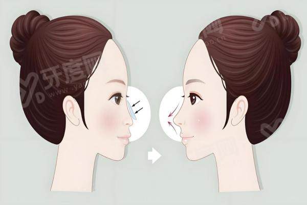 假体隆鼻用什么材料好?专业医生推荐：硅胶弹性好、膨体稳定性高、超体排异低适应性强