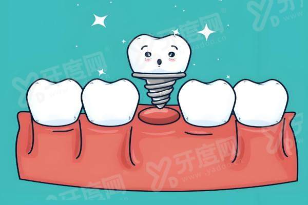 新疆阿克苏雅致口腔2026价格表：种植牙2980元起+金属托槽矫正6800元起，口碑好放心选！