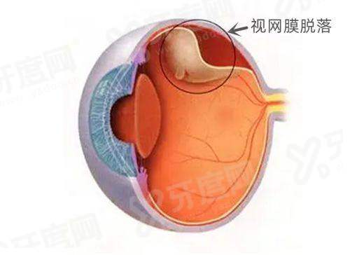 二、在辛集复明眼科医院做白内障手术，患者真实反馈怎么说？yanke.yadoo.cn