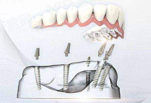 三、福州马尾维乐口腔医院价格表？（项目收费透明，性价比高）yanke.yadoo.cn