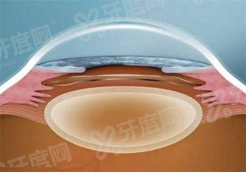 三、2026年征兵视力标准？（分裸眼、矫正及兵种，标准清晰明确）yanke.yadoo.cn