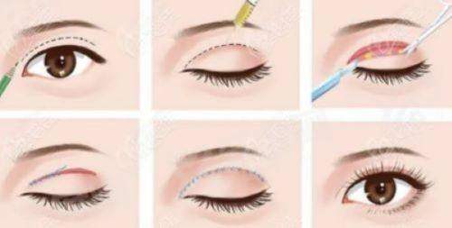 深圳东俊医疗美容门诊部可靠吗？正规资质程飚双眼皮自然，眼鼻胸整形口碑好