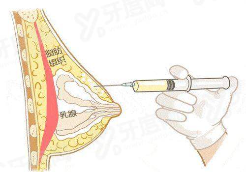北京艺美王东修复脂肪什么价格？3 万起做修复，技术精湛让轮廓自然更安心！