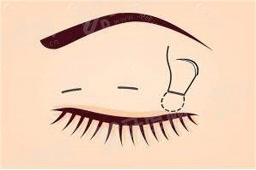 三、重庆华美脂肪填充怎么样yanke.yadoo.cn