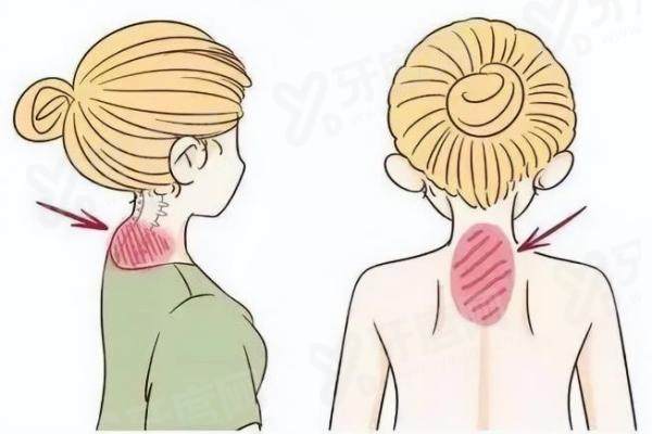 曹孟君做富贵包口碑怎么样？精准技术塑造优雅颈线，术后反馈满意度高；