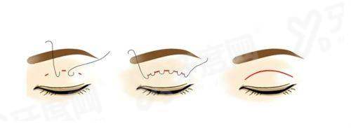 北京冯雁平做鼻子稳不稳？超稳的，不会出现变形、透光等问题！