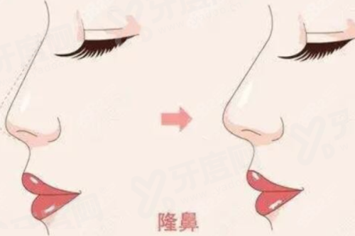 重庆晶肤医美（龙头寺院）做鼻子怎么样？微创肋软骨塑造自然妈生鼻恢复快