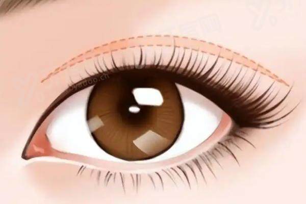 济南海峡做双眼皮真实实例反馈如何？动态重睑技术自然且价格透明，正规连锁机构值得选