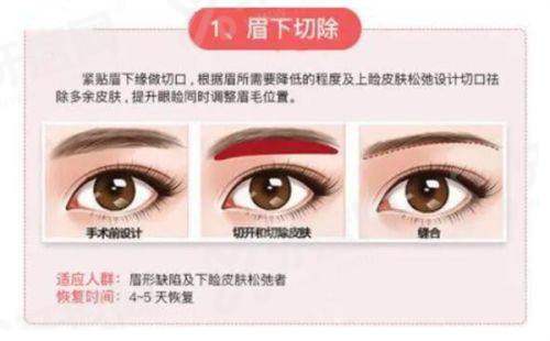 郑州刘学宝做富贵包怎么样？微创吸脂+肿胀轻恢复快，患者反馈也比较好！