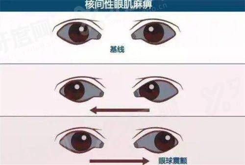 二、晶体植入适用人群有明确范围，600-2000度近视人群是主要适用对象yanke.yadoo.cn