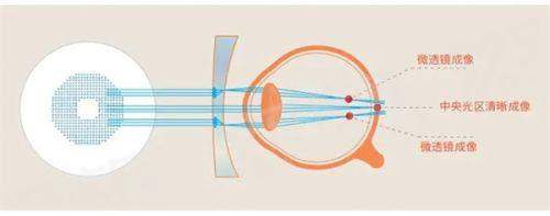 三、在郑州视献眼科医院看病怎么预约及费用多少？yanke.yadoo.cn