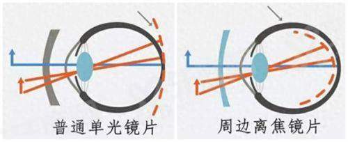 爱尔眼科飞蚊症消融术有风险吗？一般没有，专业医生操作技术成熟视力清晰