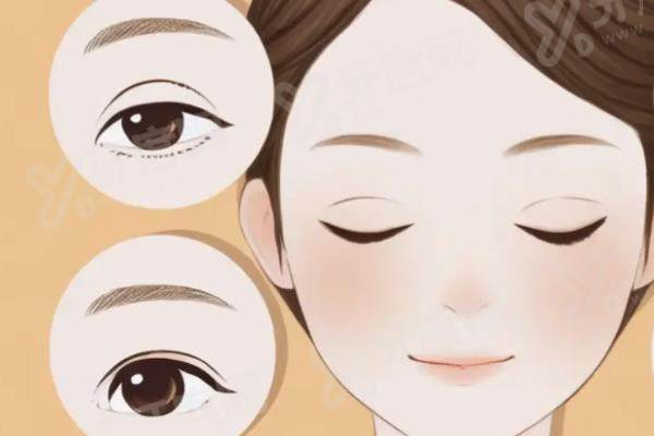 南京裴柄万双眼皮案例效果：技术细腻价格透明自然灵动