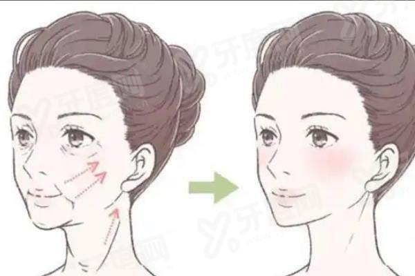 南京裴柄万做拉皮怎么样？拉皮技术精湛效果自然，价格透明合理值得选择