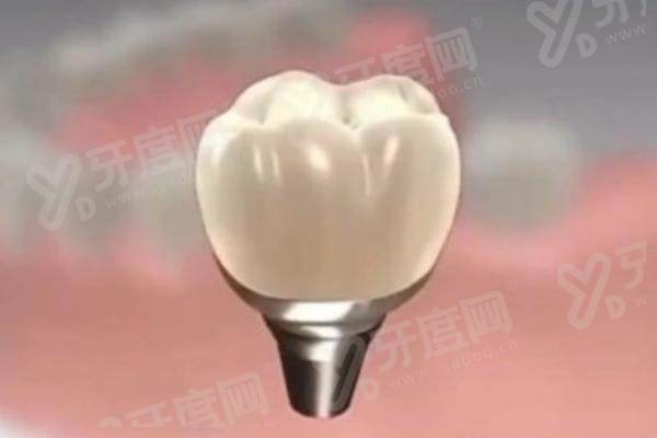 盐城双宝口腔医院做全口种植牙多少钱？8 万起 + 技术稳恢复快