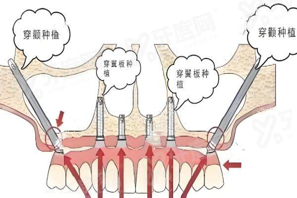 徐州医大鼎植口腔医院做全口种植牙多少钱？6 万起 + 活髓保存技术让缺牙重生更舒适