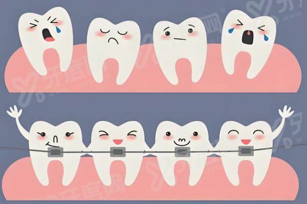 哈雷保持器可以改善深覆合吗？可辅助改善，牙性微调有效且价格透明
