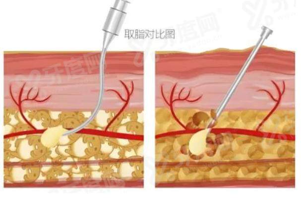 关几梦医生吸脂怎么样？精细分层技术塑形自然，属高端档次且在正规医院坐诊