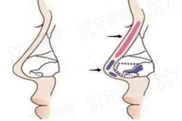 王召东医生口碑怎么样？隆鼻技术精湛效果自然