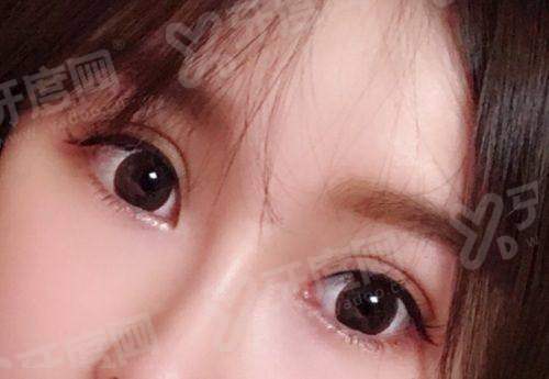 郑州东方整形美容医院朱怡梦双眼皮手术成功率高吗？精细技术塑造自然灵动双眼，术后反馈满意度高。