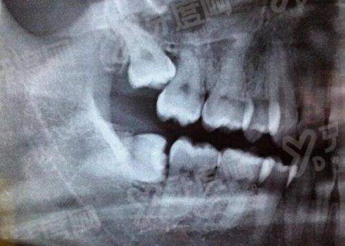 二、江苏拜博口腔医院种植牙价格表yanke.yadoo.cn