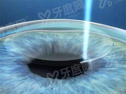 二、苏州爱尔眼科医院的医生做近视手术稳不稳？yanke.yadoo.cn