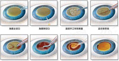 上海做近视眼手术哪家医院好？上海和平、上海新视界等医院做全飞秒技术靠谱