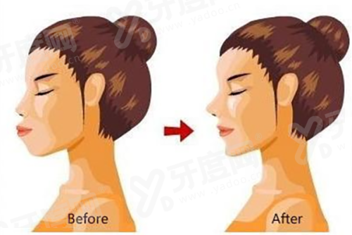 一、上海艺星孙玮奇做双眼皮怎么样?技术不错+个性化设计=自然无痕yanke.yadoo.cn