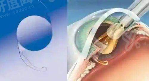 一、深圳鹏程医院朱爱平医生怎么样？盆底肌功能修复与私密修复领域yanke.yadoo.cn