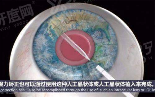 二、常德市第一人民医院眼科的医生团队技术稳吗？yanke.yadoo.cn