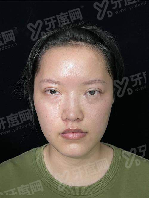 一、郑州东方整形美容医院朱怡梦眼修复手术成功几率高吗？（根据文章内容总结出明确回答字数在10-20字）yanke.yadoo.cn