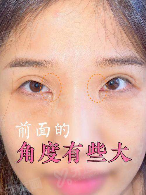 郑州东方整形美容医院朱怡梦眼修复手术成功率高吗？技术精湛患者反馈良好修复效果自然灵动