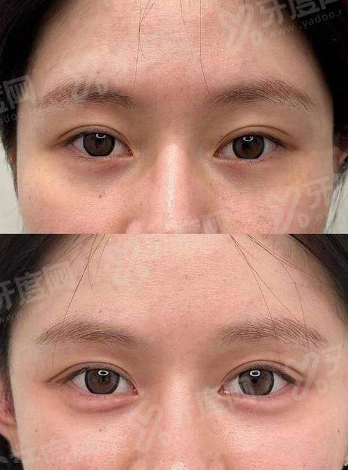 郑州东方整形美容医院朱怡梦卧蚕整形手术成功率高吗？精细化操作塑造自然卧蚕效果满意度超98%