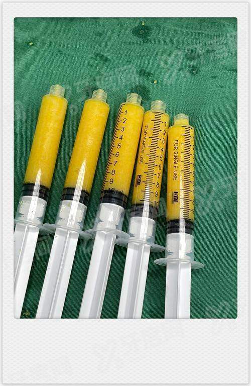 一、郑州东方整形美容医院朱怡梦吸脂塑形手术成功几率高吗？专精团队保护高成功几率yanke.yadoo.cn