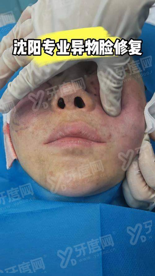 一、郑州东方整形美容医院朱怡梦异物取出手术成功几率高吗？——成功几率达98%，技术实力保护成效yanke.yadoo.cn