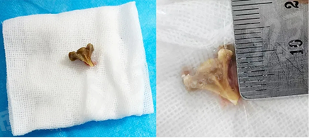 郑州东方整形美容医院朱怡梦异物取出手术成功率高吗？技术精湛医生团队确保安全取出效果佳患者满意度高