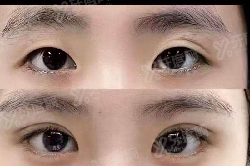 一、郑州东方整形美容医院朱怡梦双眼皮手术成功几率高吗？（成功几率高达98%，技术优势显著）yanke.yadoo.cn