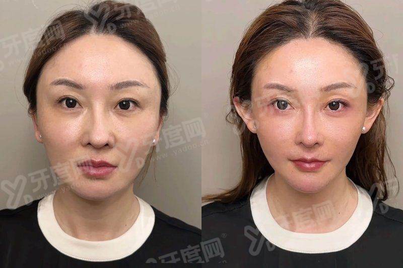 郑州东方整形美容医院收费标准如何？技术精湛医生团队打造自然灵动效果；