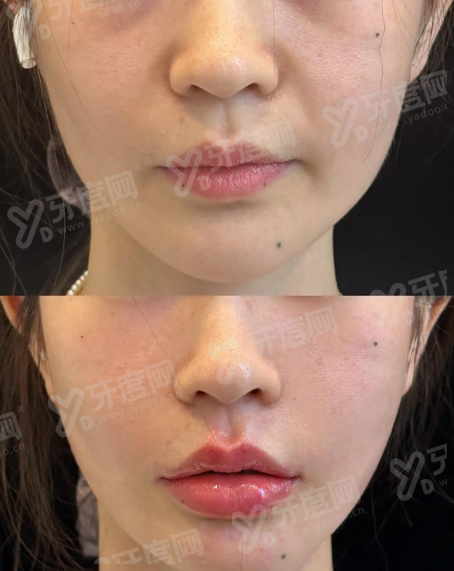 郑州东方整形美容医院朱怡梦眼部整形手术成功率高吗？多年临床经验技术精湛效果自然持久患者好评如潮