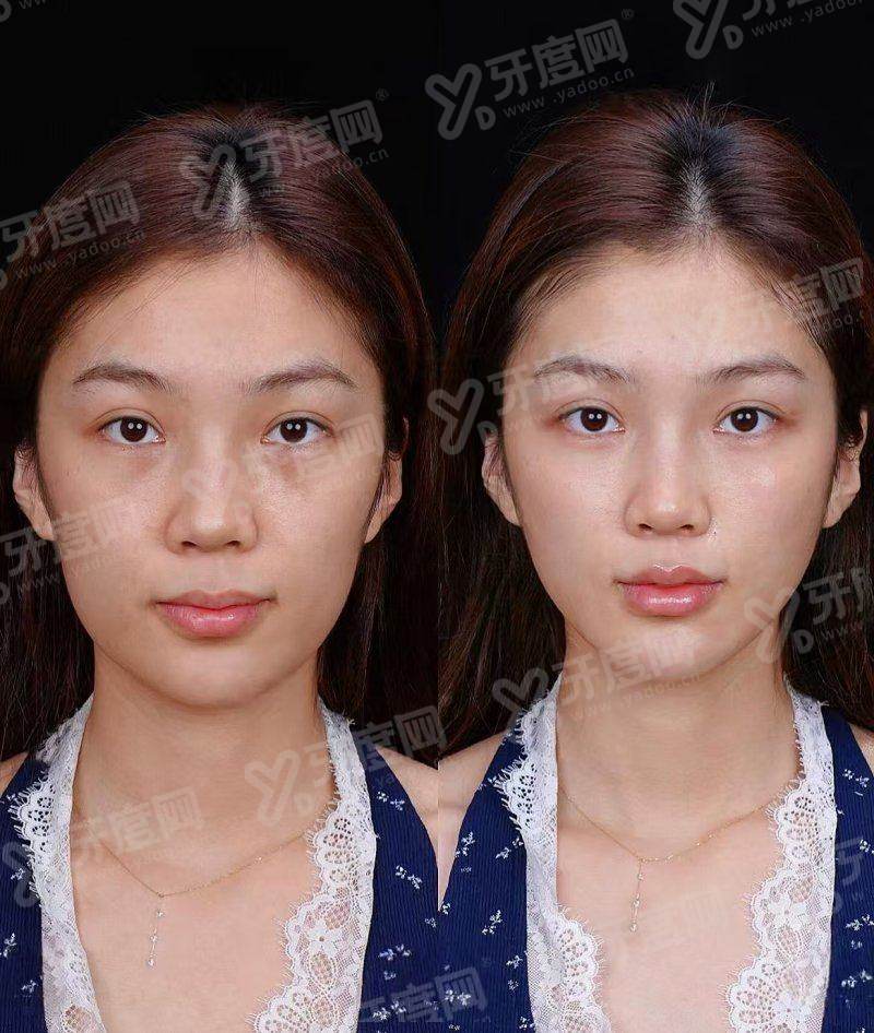 一、郑州东方整形美容医院朱怡梦口唇整形手术成功几率高吗？（根据文章内容总结出明确回答字数在10-20字）yanke.yadoo.cn