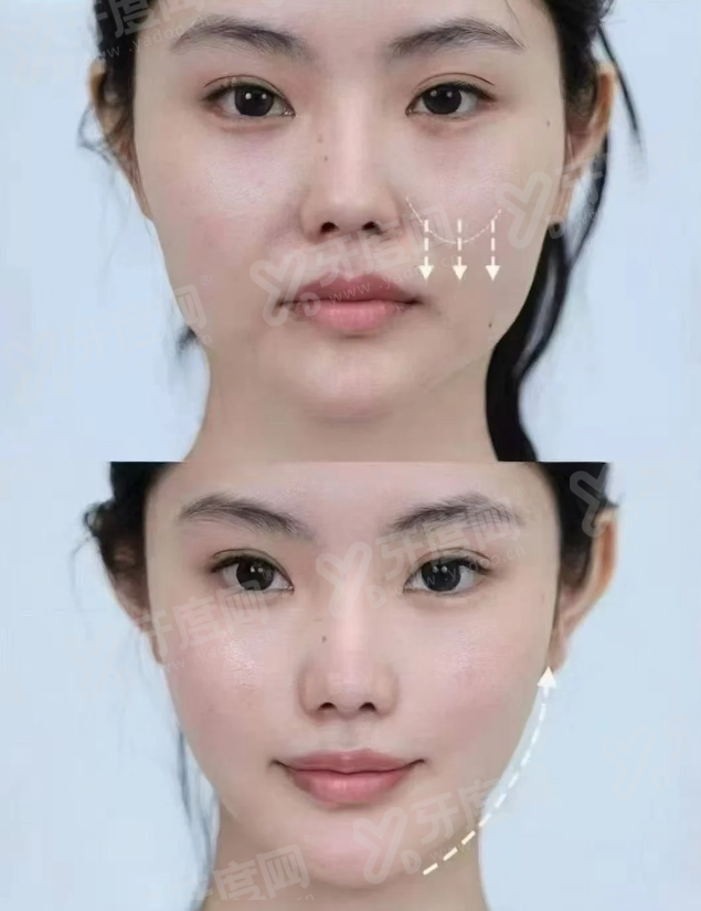 郑州东方整形美容医院朱怡梦口唇整形手术成功率高吗？专业团队精湛技术助力自然美唇效果显著