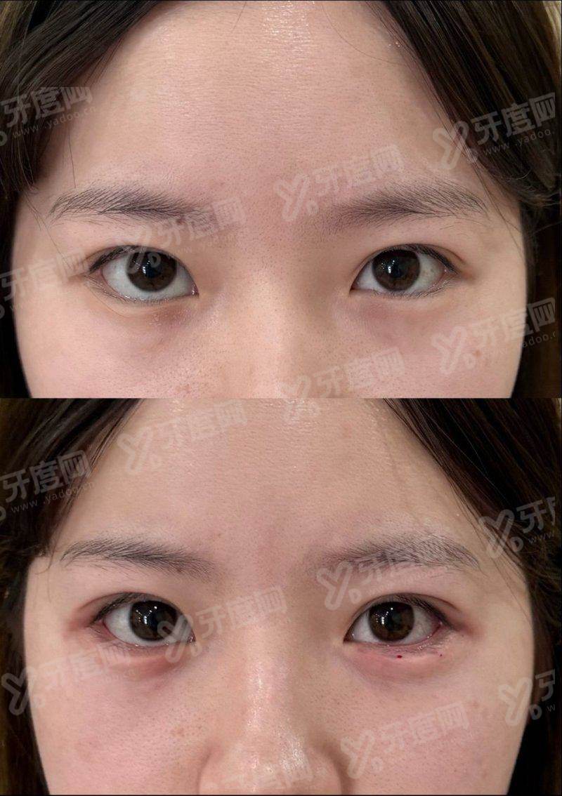 二、如何预约郑州东方整形美容医院朱怡梦医生的卧蚕整形手术?yanke.yadoo.cn